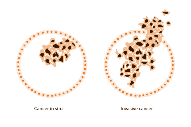 An image of cancer in situ cell and invasive cancer cell.