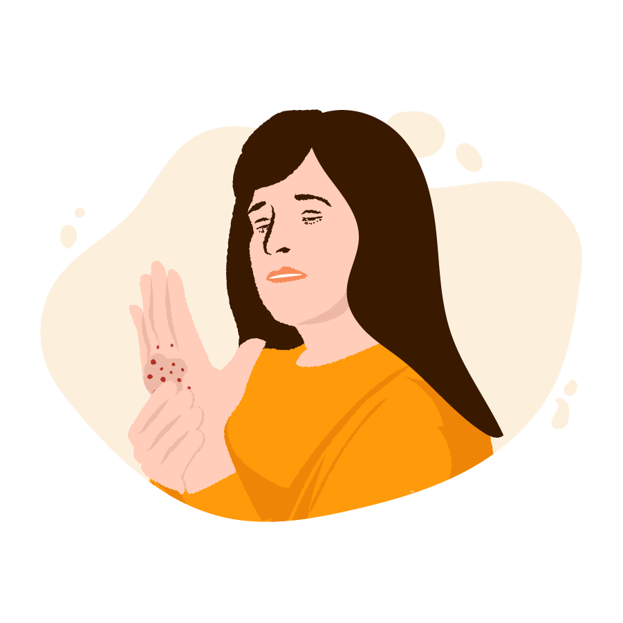 An image of a girl having a skin rash on her hand.
